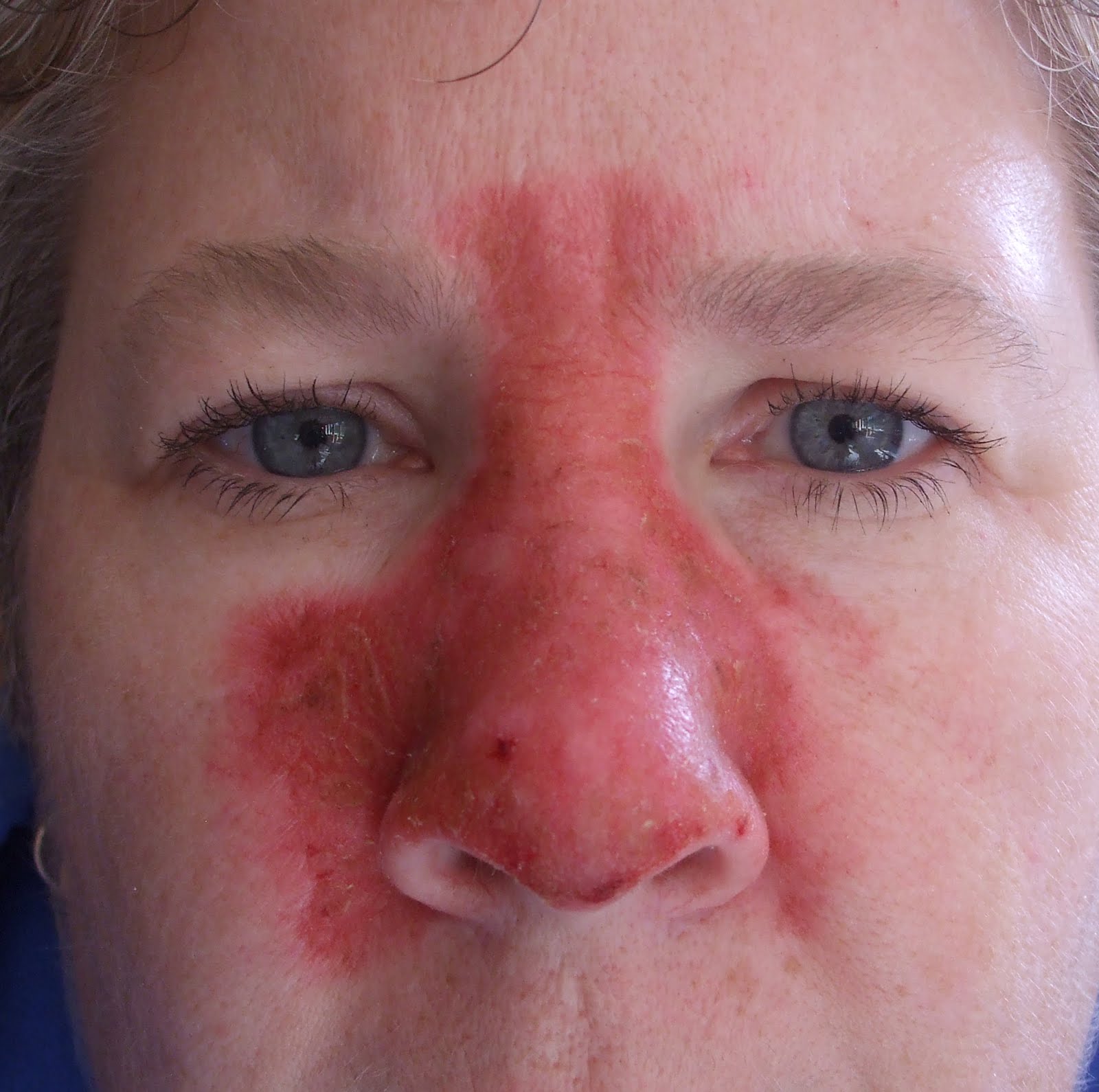 Skin Cancer On Nose Symptoms