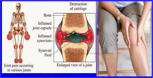 Cara Menyembuhkan Penyakit Nyeri Sendi Secara Alami