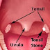 Tonsil Bad Breath and Tonsil Stones