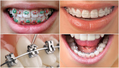 Các giải pháp niềng răng phổ biến