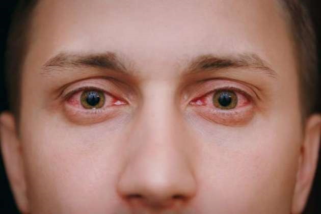  Red eyes signal loss of sight