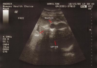 2nd Ultrasound Face labeled