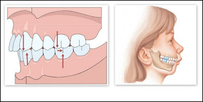 Răng hô vẩu và phương pháp điều trị thích hợp