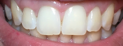 example of my teeth after using the carbon coco kit for 4 nights