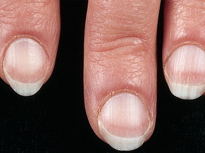 √70以上 club fingernails picture 292219-What is clubbing of the nails pictures