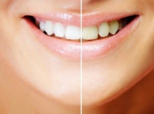 Cause Yellow Teeth along with also How To Overcome This kind of