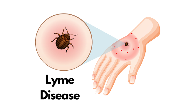 Lyme disease: A Thorough Investigation