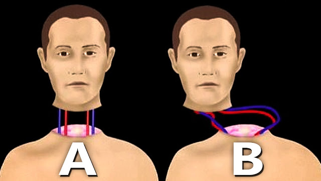 Transplantasi kepala manusia pertama di dunia