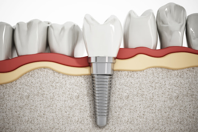 Dental implants Blakeshurst