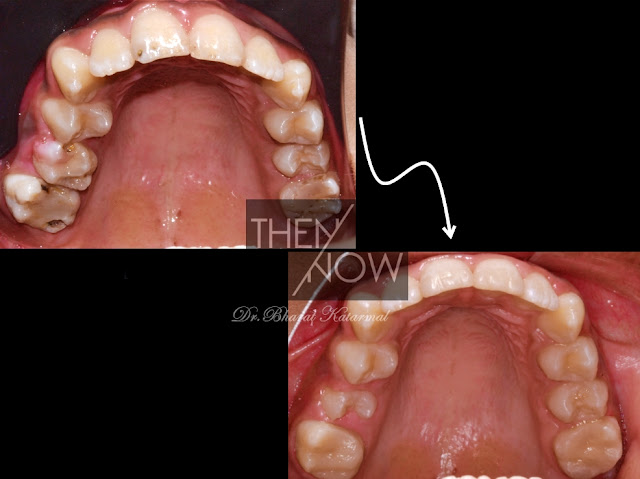 Treatment of Amelogenesis Imperfecta with composite Filling