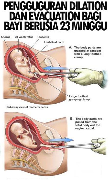 Wancikgumuzik Iisshhhkkk Cara Cara Menggugurkan Bayi