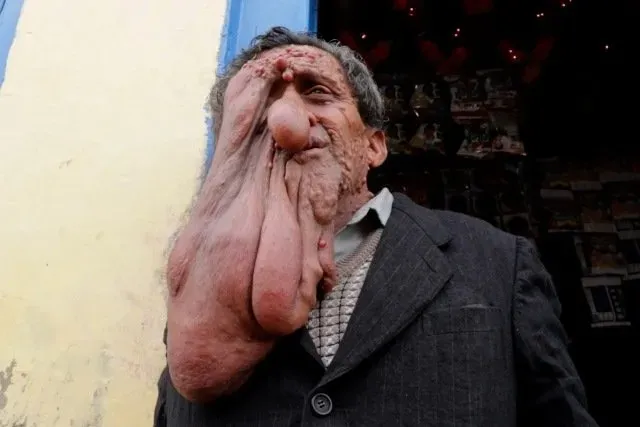 This man’s face seems to be melting due to a rare disease