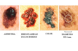<Img src = "distintas clases de cancer de piel.jpg". width = "150" height "20" border = "0" alt = "tipos de cancer de piel">