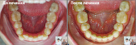 Форма нижнего зубного ряда до и после ортодонтического лечения