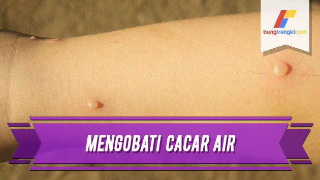 Cara Menyembuhkan Cacar Dengan Cepat Menggunakan Bahan Alami