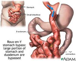 CORETAN HIDUP: Gastrik Menyerang Lagi