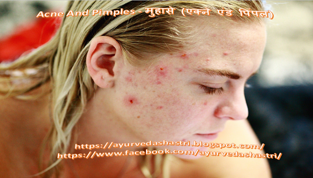 Acne and Pimples - मुहासे (एक्ने एंड पिंपल) 