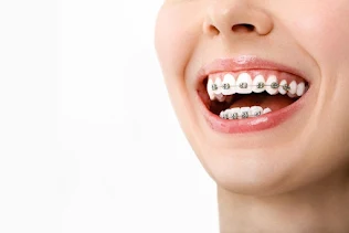 Oral Care While Wearing Braces