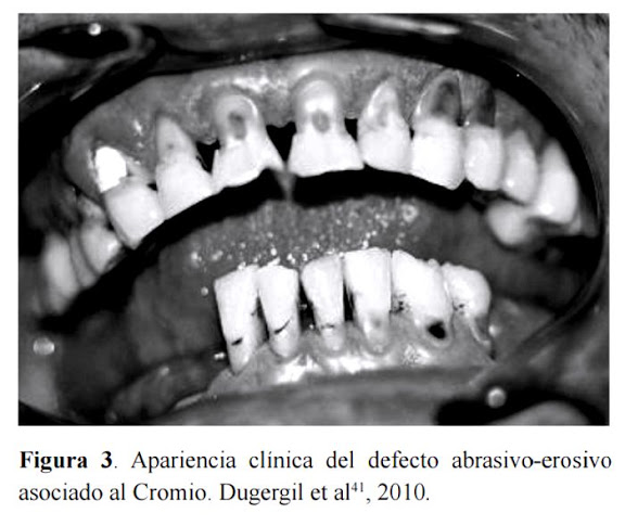 PDF: Diagnóstico y epidemiología de Erosión Dental