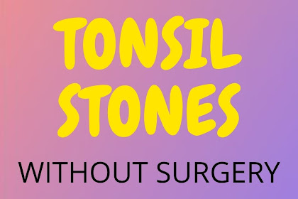 4 EFFECTIVE WAYS TO REMOVE TONSIL STONES WITHOUT SURGERY