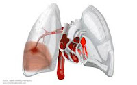 Embolie pulmonaire (EP ) est une pathologie extrêmement fréquente et hautement mortel qui est une des principales causes de décès dans tous les groupes d'âge .