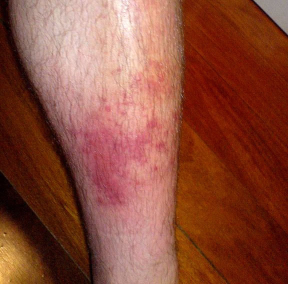 What is cellulitis - What causes cellulitis infection | the dynamic ...