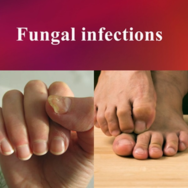 Best herbs for treatment of fungus (fungal infections) of the skin, toes, nails and other body parts.