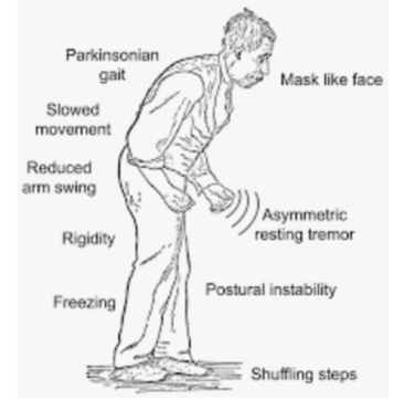 Parkinson's Disease Treatment A big breakthrough