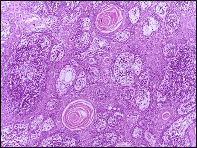 Cutaneous Squamous Cell Carcinoma (cSCC)