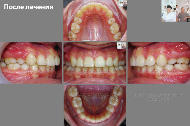 Фото. Прикус пациента после лечения металлическими брекетами