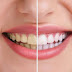 10 Cara Memutihkan Gigi Secara Alami