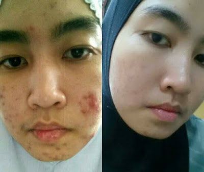 Testimoni Kulit Berseri Dan Anjal Dengan Produk Shaklee