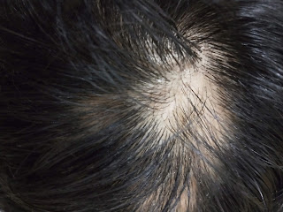 Alopecia areata is the sudden hair loss where  coin like Bald patches are seen on the scalp.  It is an autoimmune condition in which the hair losses unpredictable.  It can occur in any age. Most cases are seen in the age before 30 years.  It can be seen in any gender.   In this condition, our n immune system attacks our own hair follicles. Due to which hair follicles shrink, and hairs fall down.  Links and associations+ 1. The person suffering from allopathic areata has a greater risk of having other autoimmune diseases like  thyroiditis, vitiligo, pernicious anaemia 2. Collagen vascular diseases 3. Common with down syndrome 4. Stress, anxiety, depression  Extreme stress is a trigger for allopathy areata.  Symptoms-  1. Hair loss- round, coin sized bald patches on scalp  2. Hair loss can be sudden or develop in some days or weeks. 3. The area of hair loss appears smooth 4. Sometime,s growth of beard and eyelashes are also affected 5. No Itching, redness or burning sensation over the scalp 6. Nails - small dents, white spots or lines   Types-  1. Localised allopesha areata - hair fall occurs in small, localised patches 2. Alopecia areata totalis- complete hair loss over the scalp 3. Alopecia areata universalis- hair loss occurs a over the full body, that is from scalp eyebrows eyelashes beard and gradually from all over the body. 4. Diffuse alopecia areata- appears like male or female pattern baldness. 5. Ofiatic alopecia area- hair loss occurs on the sides are back of scalp  Diagnosis- 1. Biopsy 2. Blood tests  The chances of recovery are high  Allopesha areata is a recurrent condition. That is it can occur again and again at an interval of few months or years.  Myths+ 1. Caused by a worm 2. Side effect of a drugg or medicine 3. Related to any food or water 4. Can be treated by applying coconut oil or onion juice
