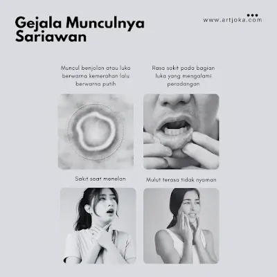 gejala sariawan