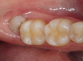 Quais são os sintomas do dente do siso nascendo? Saúde no Clique