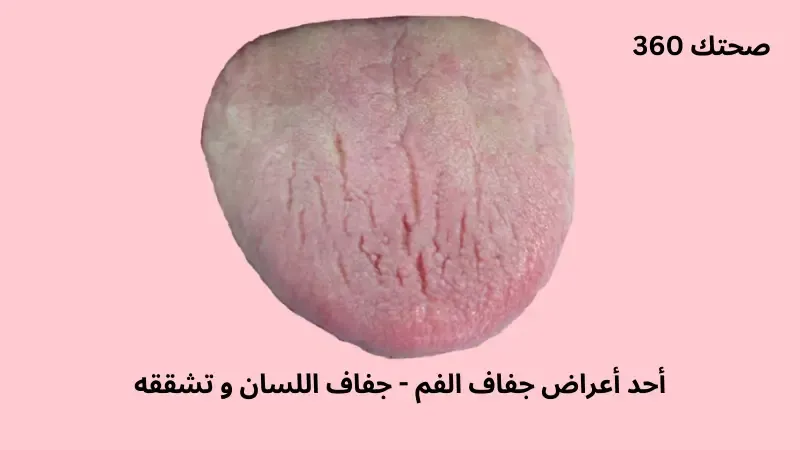 جفاف اللسان وتشققه