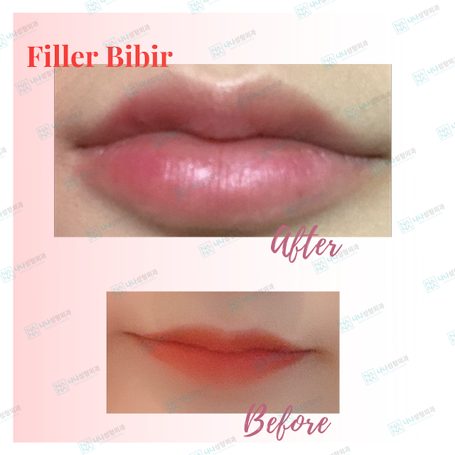 filler bibir, lip filler, filler, suntik filler, botox, botox ujung bibir, bibir sexy, bibir bervolume, bibir indah, dermatologi, dermatologi korea, perawatan dermatologi, dokter korea, dokter dermatologi