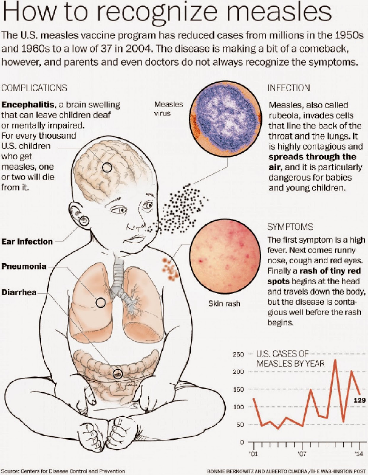 Kenali Tanda-tanda Demam Campak (measles) ~ Coretan Jiwa 