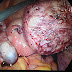 Successful laparoscopic removal of a big uterine fibroid-Laparoscopic Myomectomy