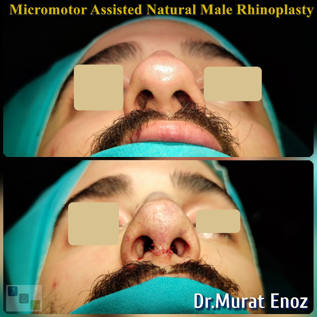 Micro-motor assisted male rhinoplasty - Nose job for men - Crooked nose aesthetic in Istanbul