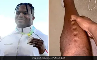 What kind of disease is this? The body becomes like kneaded flour, where you press, there is a pit, Olympian Lawrence was a victim of this deadly disease. Sharing the video, Mr. Okoe wrote in the caption, "Warning! Don't look if you're timid" Okoe claimed that the infection started after his leg was broken.  According to a report in Fox News, British Olympian and former American football defensive tackle Lawrence Okoe has fallen victim to a rare disease. In December, he shared a video on his Instagram in which he is seen pressing the front of his foot six times with his thumb. Even after the pressure was released, his skin had a thumb impression, as if a dough had been pressed.  Sharing the video, Mr. Okoe wrote in the caption, "Warning! Don't look if you're timid..."  According to a report in the New York Post, the player said on TikTok that "it feels like I am made of playdoff".  The athlete later revealed in another TikTok video that he has suffered from a skin-related disease called cellulitis. Okoe claimed that the infection started after his leg was broken.  According to the Centers for Disease Control and Prevention, "Cellulitis is a common bacterial skin infection that causes redness, swelling, and pain in an infected area of the skin." If not treated at the right time, the infection can spread to a deep layer of facial lining, tissue. In addition, cellulitis can result in shock, amputation, and even death.  Cellulitis is often referred to as the 'silent killer'. Mr. Okoe said in the TikTok video, "People believe that I have many other diseases. "Many people were trying to tell me that I have heart disease or liver disease, kidney disease, cancer and diabetes, but obviously that is not the case. I had an infection called cellulitis. It's basically bacteria that gets into your system from an open wound," he added, adding, "The crazy holes that were in my leg don't exist anymore."