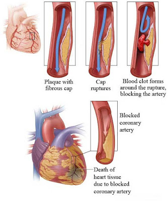atherosclerosis complications