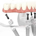 Cấy ghép Implant tức thời khi nào?