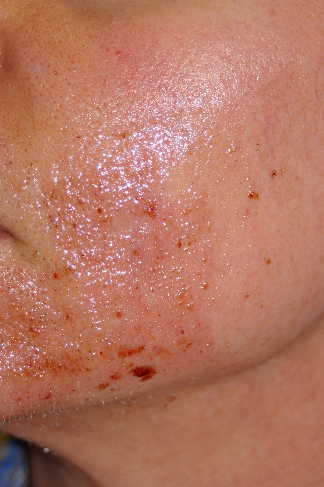... images day 2: Sciton profractional | Botox Dermal Fillers Laser Sydney