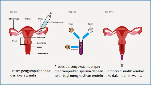 Image result for Proses IVF