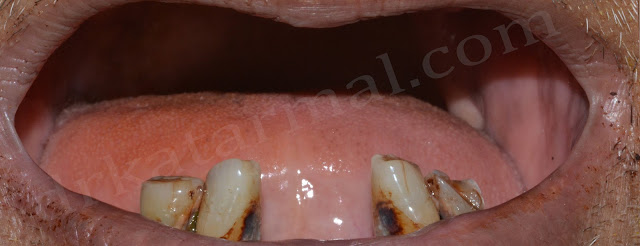 Only Few teeth Before Treatment