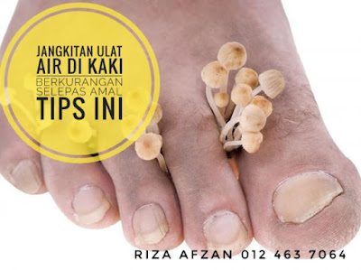 Jangkitan ulat air di kaki