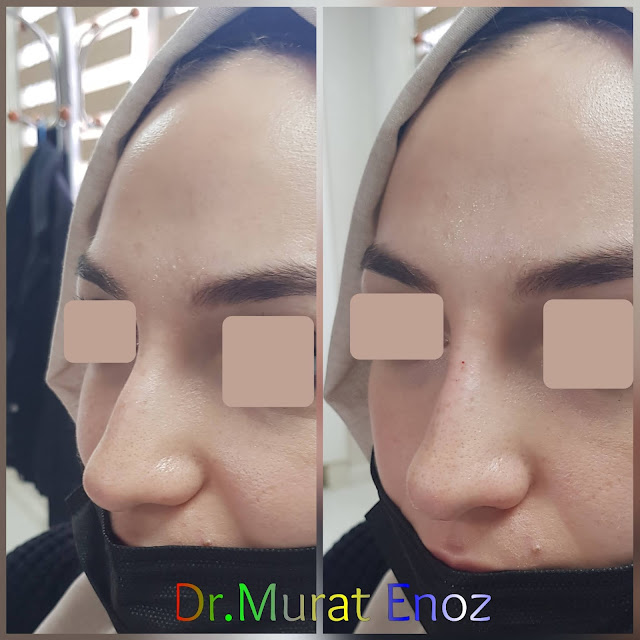 Non-surgical rhinoplasty with filler istanbul