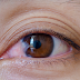 Pterygium (Surfer's Eye): What Causes it and its Symptoms