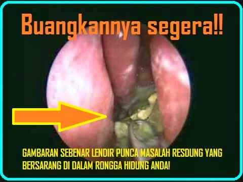 Rawatan resdung paling berkesan